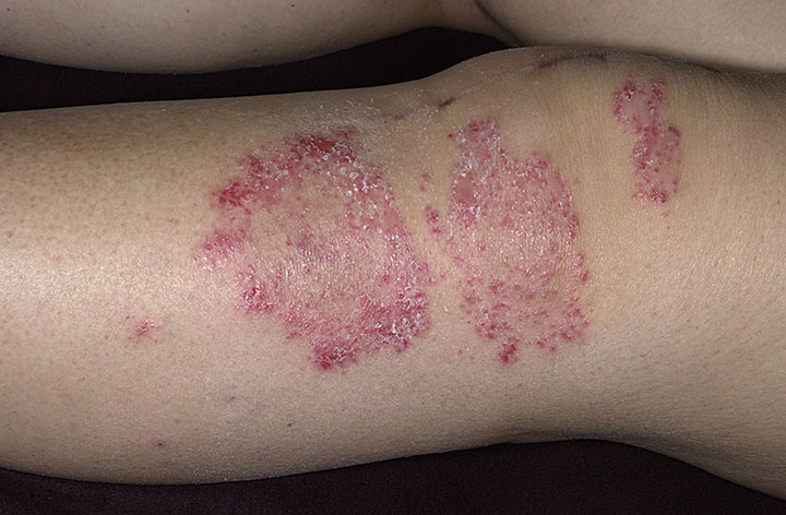 Atopic Dermatitis/Eczema in Children - Allergy UK